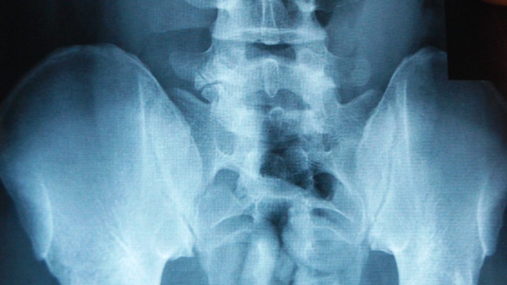  Une radiographie montre plusieurs sacs dans l'estomac d'une personne, probablement remplis de drogues.  